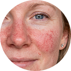 Rosacea